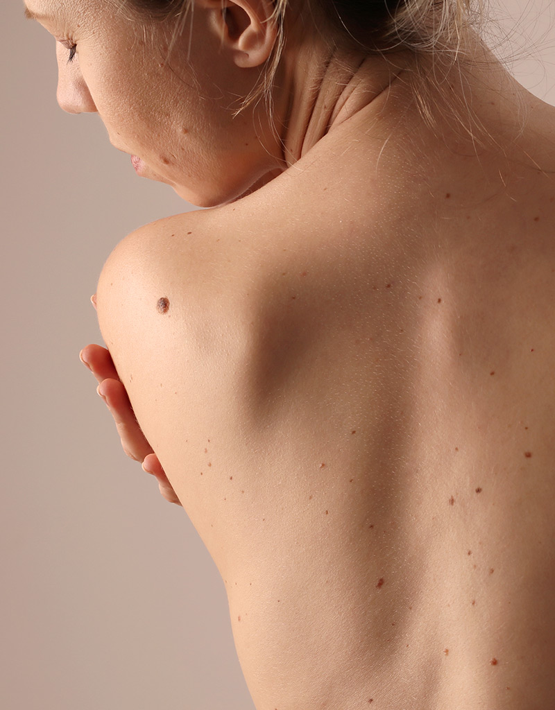 Donna che si guarda le imperfezioni della pelle sulla schiena