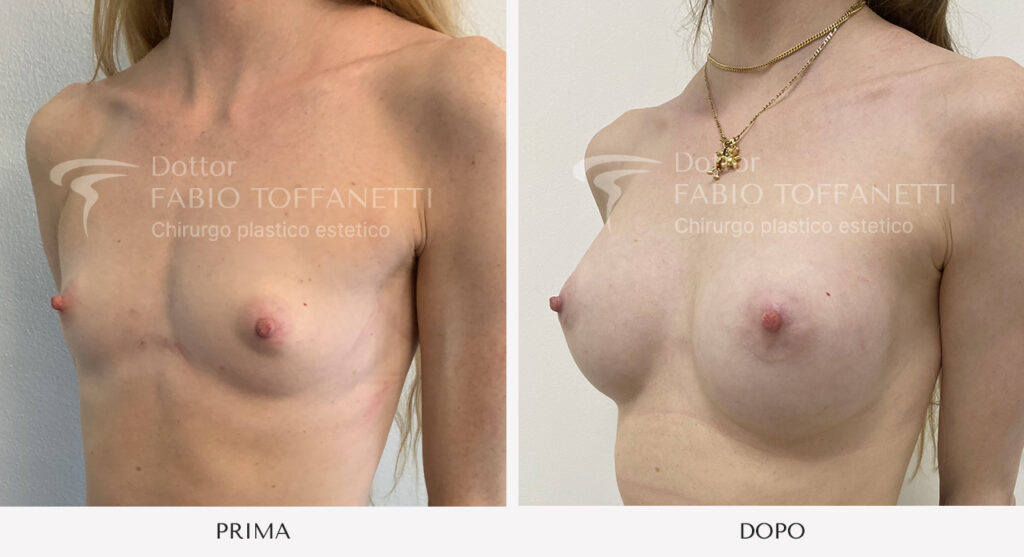 Prima e dopo mastoplastica additiva seno