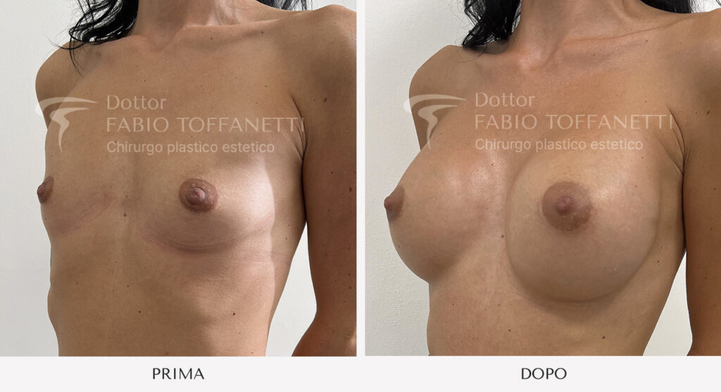 Prima e dopo mastoplastica additiva seno