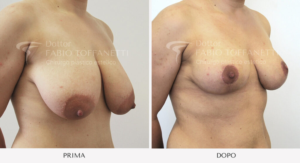 Prima e dopo mastoplastica riduttiva seno