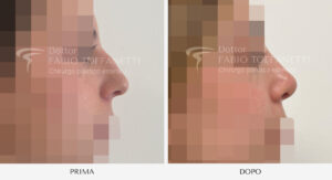 Rinosettoplastica Dottor Fabio Toffanetti