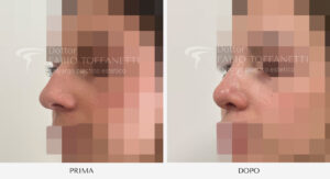 Rinosettoplastica Dottor Fabio Toffanetti
