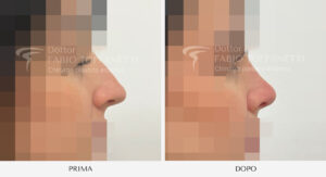 Rinosettoplastica Dottor Fabio Toffanetti