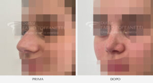 Rinosettoplastica Dottor Fabio Toffanetti