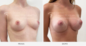 Mastoplastica additiva Dr Toffanetti