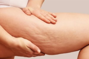 Mesoterapia Dr Fabio Toffanetti