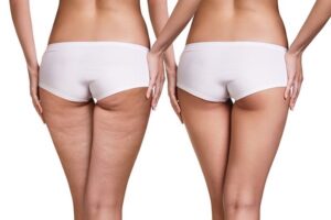 Mesoterapia Dr Fabio Toffanetti
