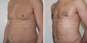 Liposuzione Dr Fabio Toffanetti