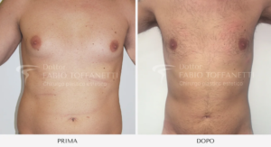 Liposuzione Dr Fabio Toffanetti